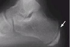 Case Study using the SFMA&##x2f;FMS on a Junior High athlete with Sever&##x27;s Disease