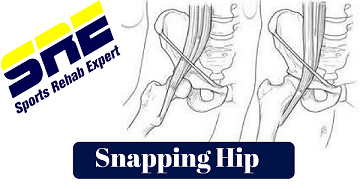 Snapping Hip Syndrome