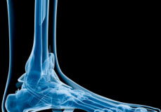 Cuboid Syndrome - Diagnosis and Management of the Often Forgotten Cause of Lateral Foot Pain
