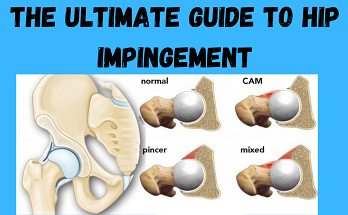 The Ultimate Guide to Recovering from Hip Impingement Without Surgery
